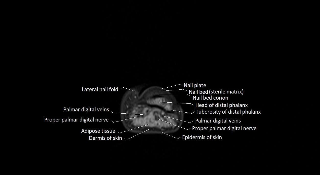 Finger anatomy axial cross sectional 3T image image 3.webp